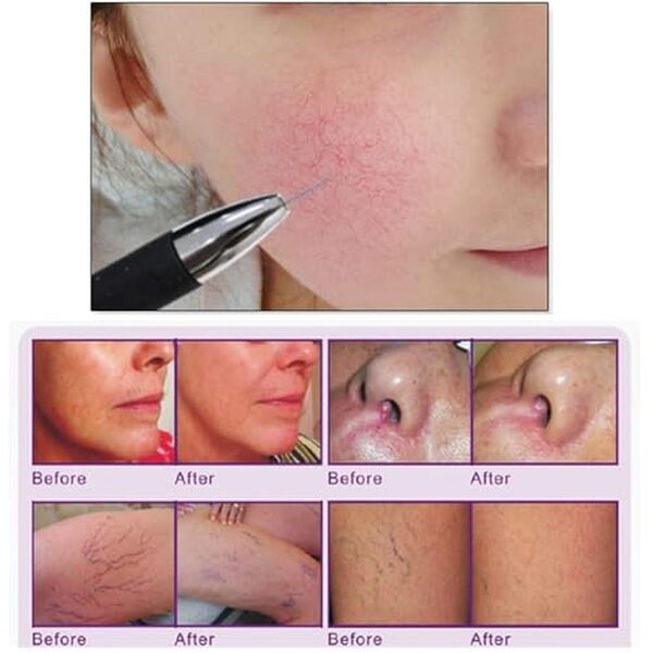 Découvrez notre test complet du Qiang Instrument, la machine RF révolutionnaire pour traiter les varicosités. Résultats, avantages et avis d'experts inclus. 